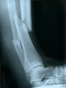 car accident injury