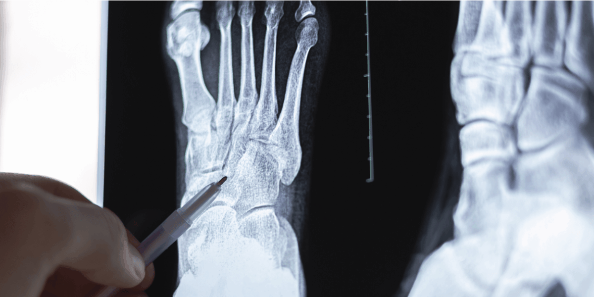 accident-lawyer-newport-beach:-legal-support-for-broken-or-fractured-bone-injuries
