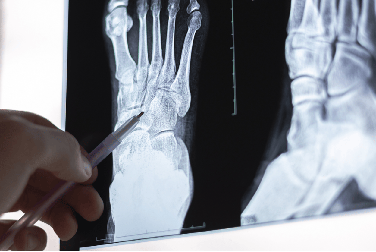accident-lawyer-newport-beach:-legal-support-for-broken-or-fractured-bone-injuries