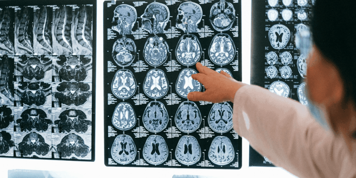 suffering-a-traumatic-brain-injury?-call-a-long-beach-car-accident-lawyer-today