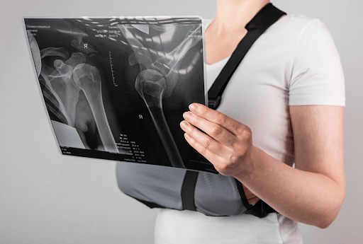 from-x-rays-to-compensation-how-a-redlands-car-accident-attorney-handles-bone-fracture-cases