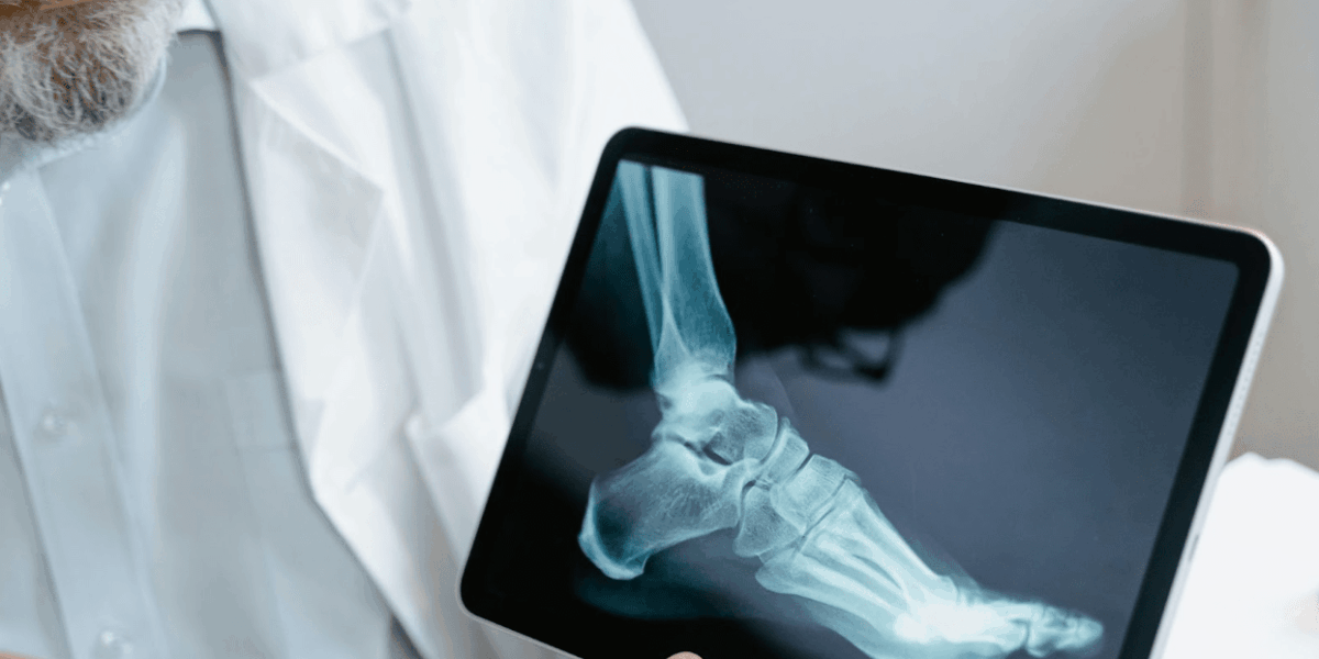 how-a-broken-bone-can-lead-to-major-injury-claims