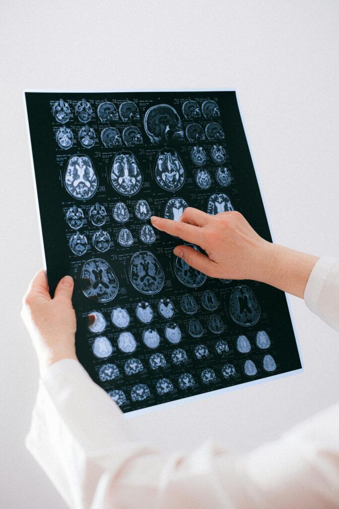 brain injury 2