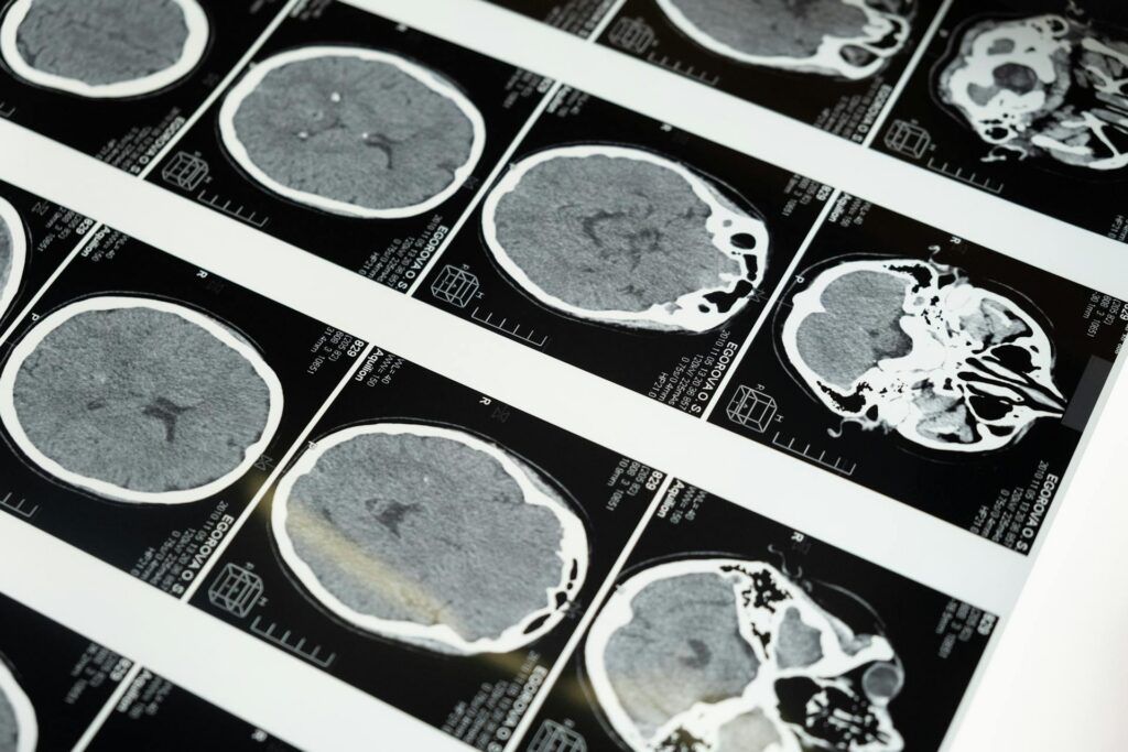 brain injury 3