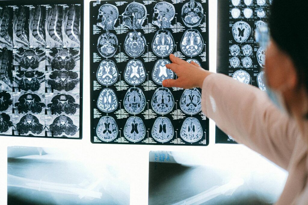 Suffered a Brain Injury in Los Angeles?